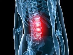 Az ágyéki gerinc osteochondrosis