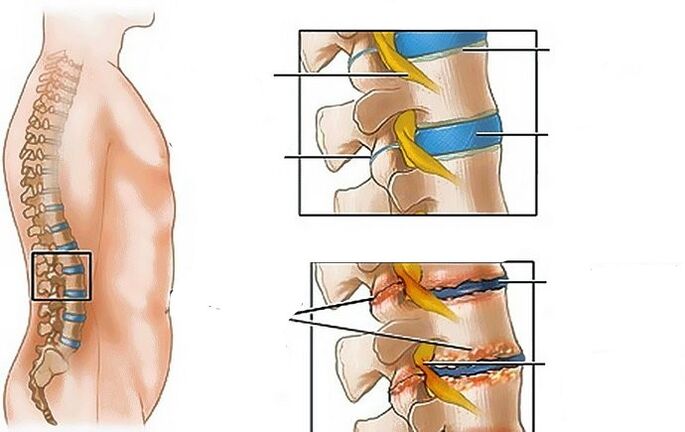 Az ágyéki régió osteochondrosis