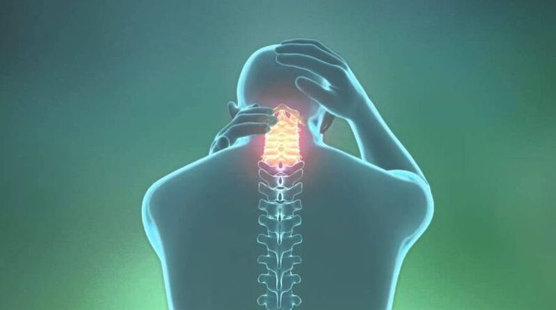 A méhnyakos régió osteochondrosis