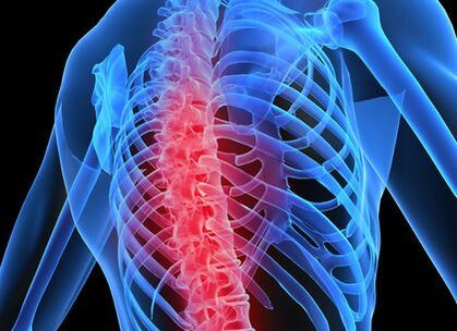 a mellkasi gerinc osteochondrosisa