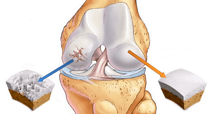 egészséges porc és arthrosis által érintett porc