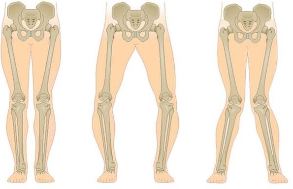 az arthrosis típusai