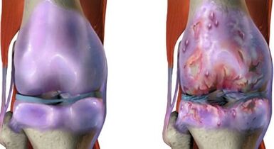 Az ízületi gyulladás és arthrosis fő különbségei