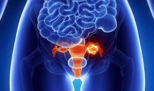 provokáló tényezők az ágyéki gerinc osteochondrosisának kialakulásához