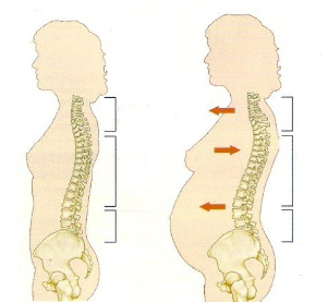 osteochondrosis terhesség alatt